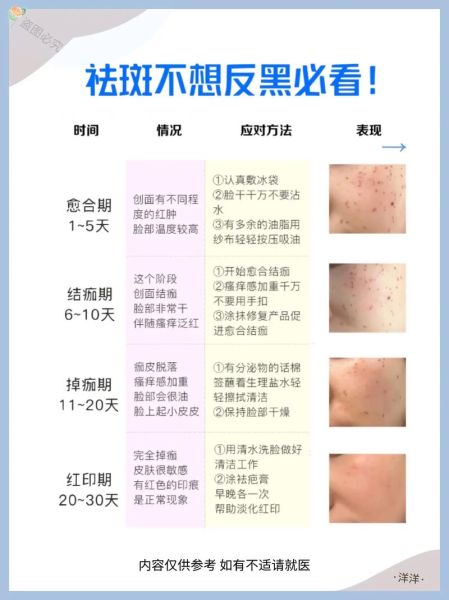 祛斑最有效的方法是什么_祛斑后会不会反弹-第1张图片-俊逸知识馆 祛斑最有效的方法是什么_祛斑后会不会反弹-第1张图片-俊逸知识馆