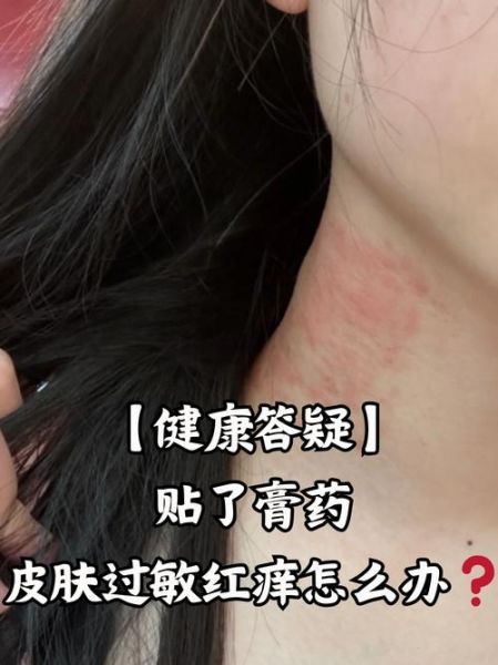 膏药贴多久换一次_膏药过敏怎么办-第2张图片-俊逸知识馆